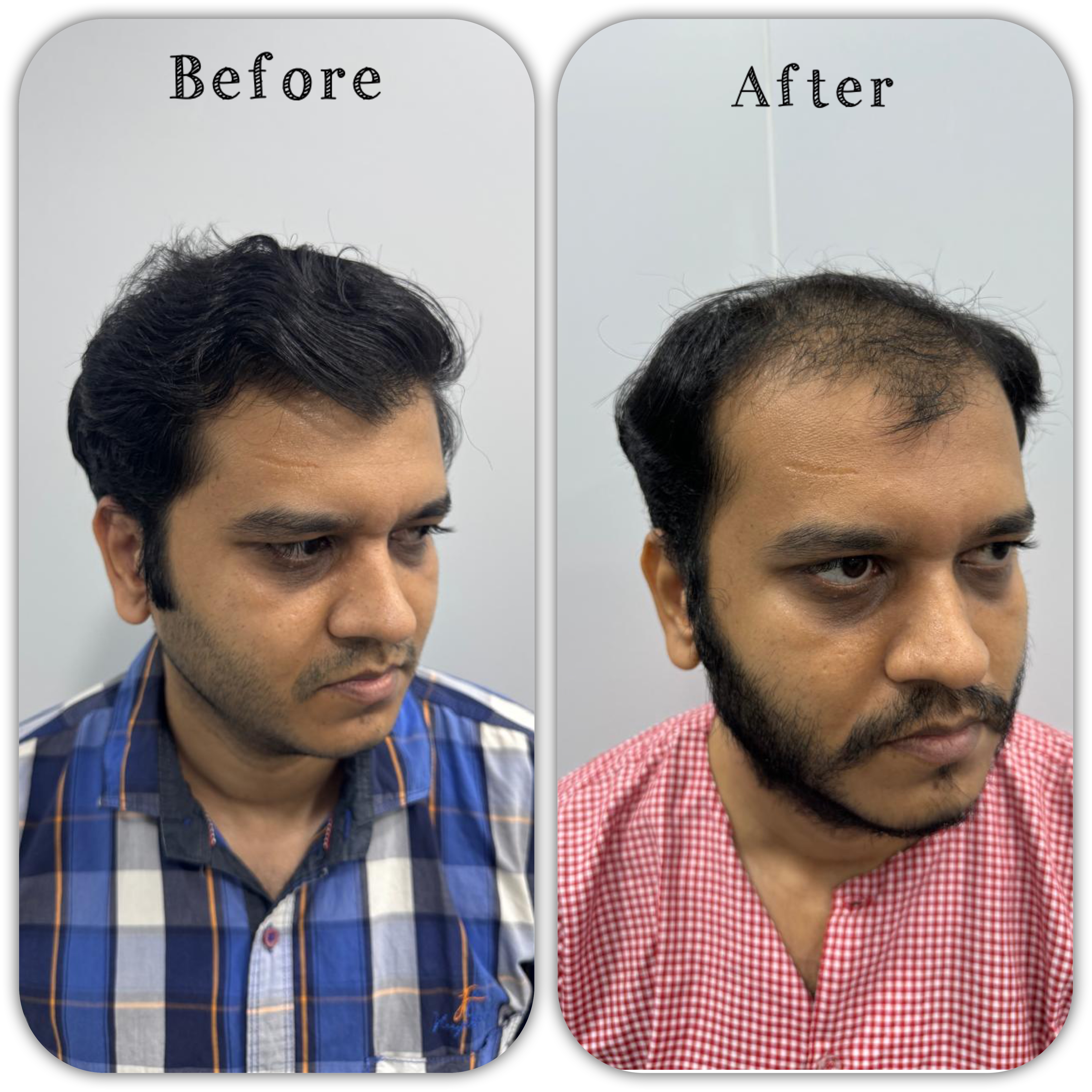 Hair transplant result 2